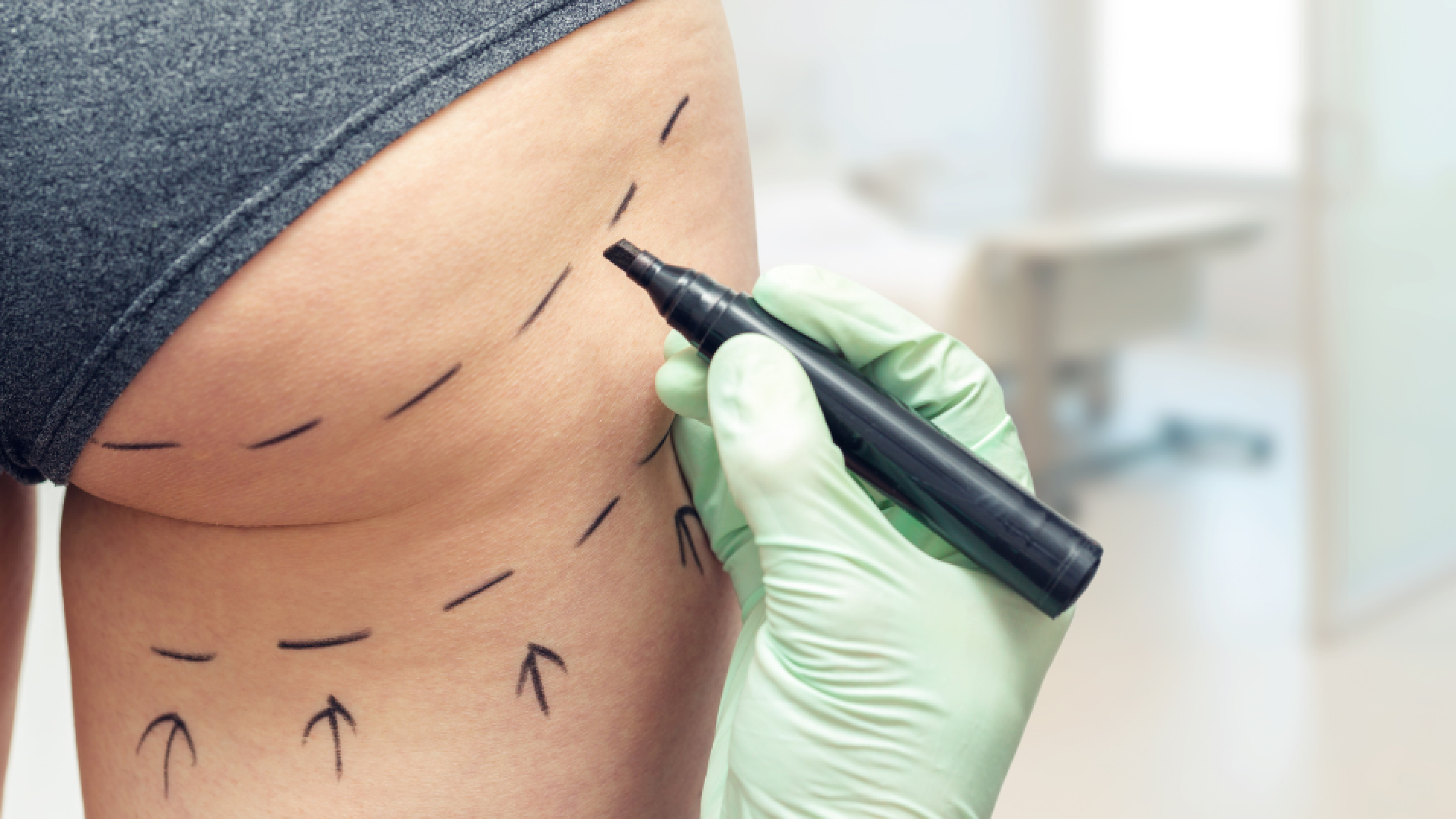 Reino Unido ataca 'Brazilian butt lift': mais uma ofensiva